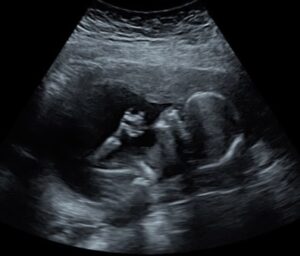 Diagnostic OB/GYN ultrasound scan performed at Sneak-a-Pic Ultrasound & Spa in Sugar Land Houston, TX.